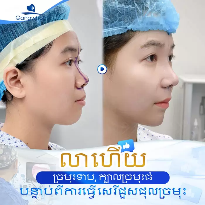 km nang mui nanoform 3