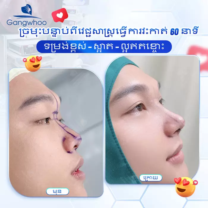 km nang mui nanoform 4