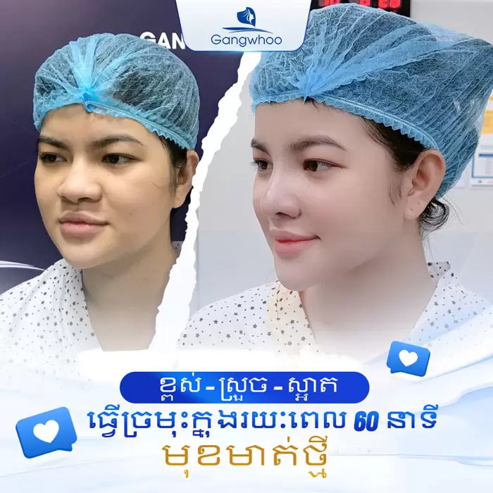 km nang mui nanoform 6