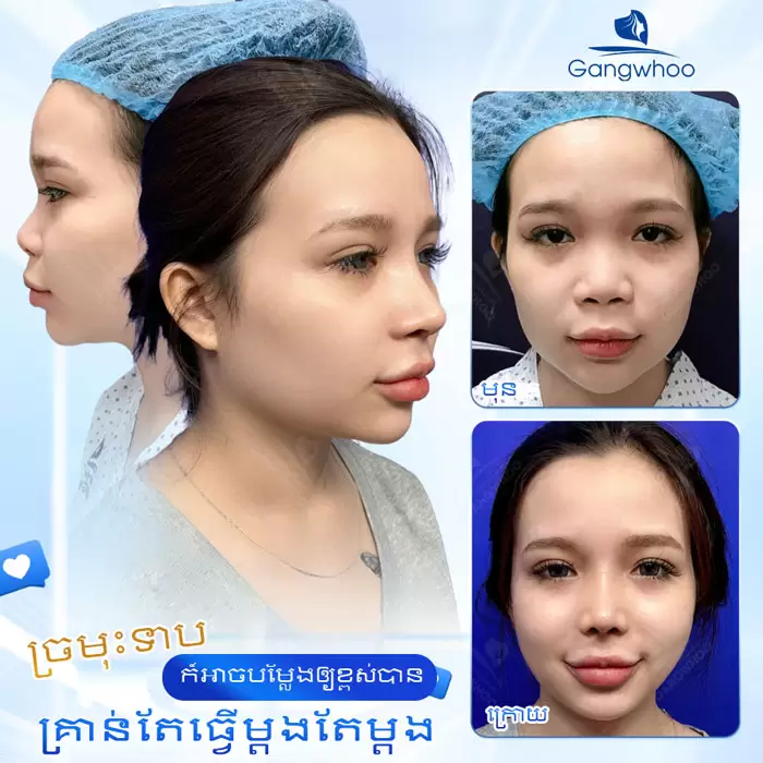 km nang mui sun sugiform 2