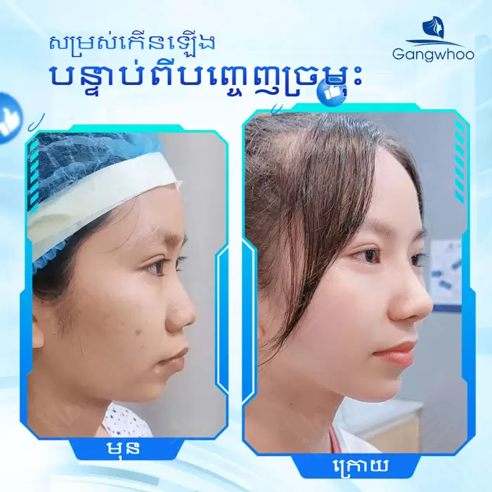 km nang mui sun sugiform 3