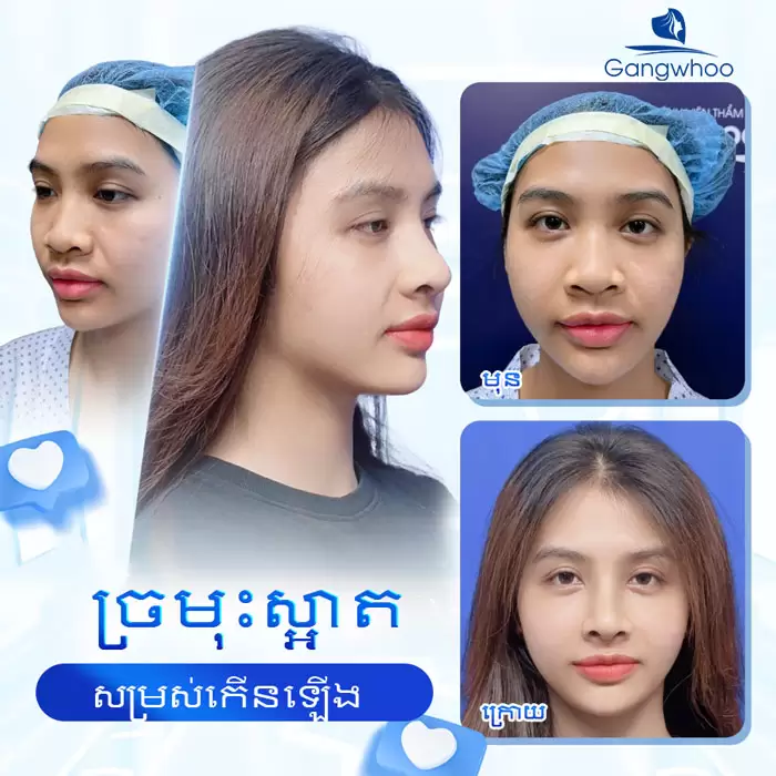 km nang mui sun sugiform 6