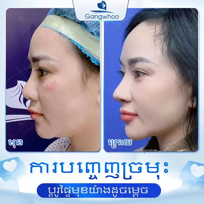 km nang mui sun sugiform 7