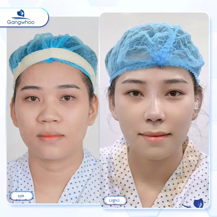 km nang mui sun suon 4