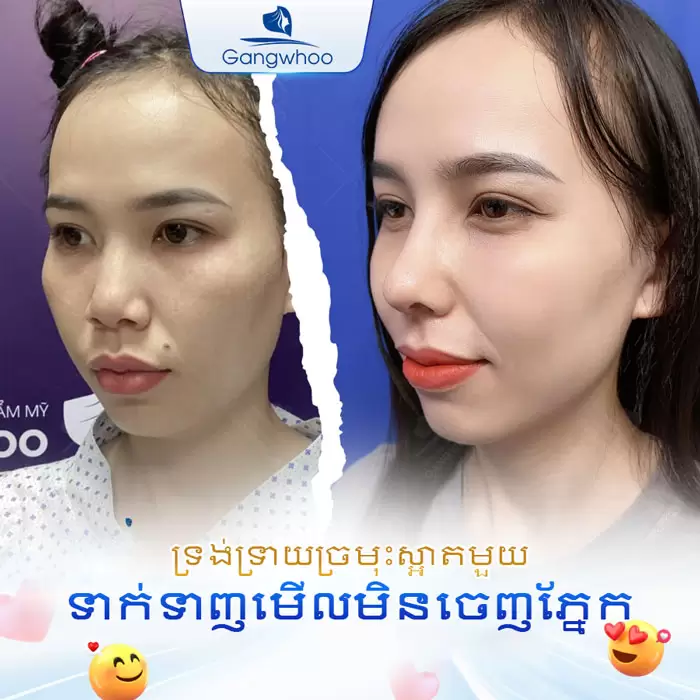 km nang mui sun suon 5