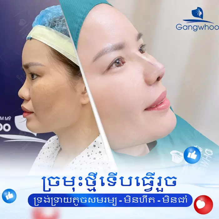 km nang mui sun suon 7