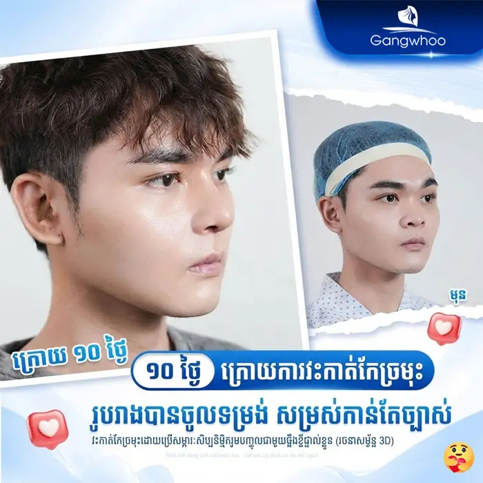 km phau thuat nang mui 1