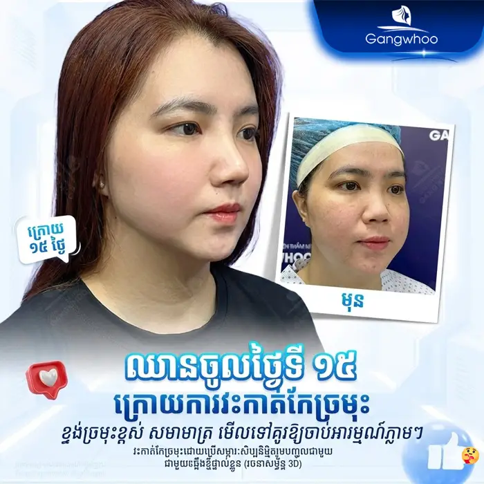 km phau thuat nang mui 10