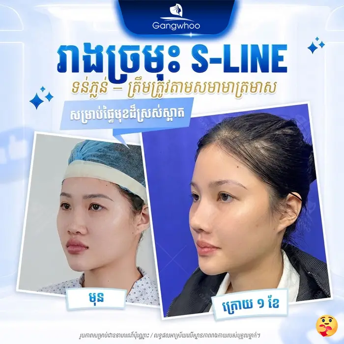 km phau thuat nang mui 2