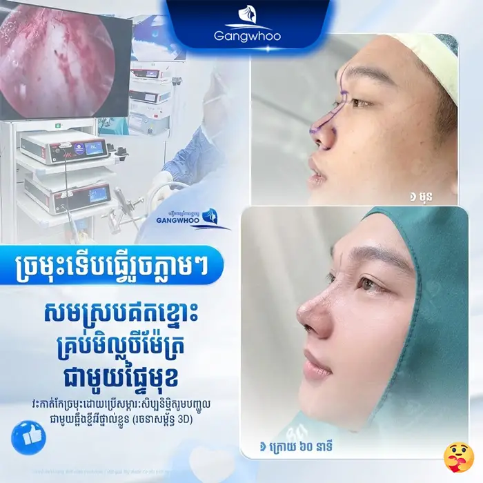 km phau thuat nang mui 3