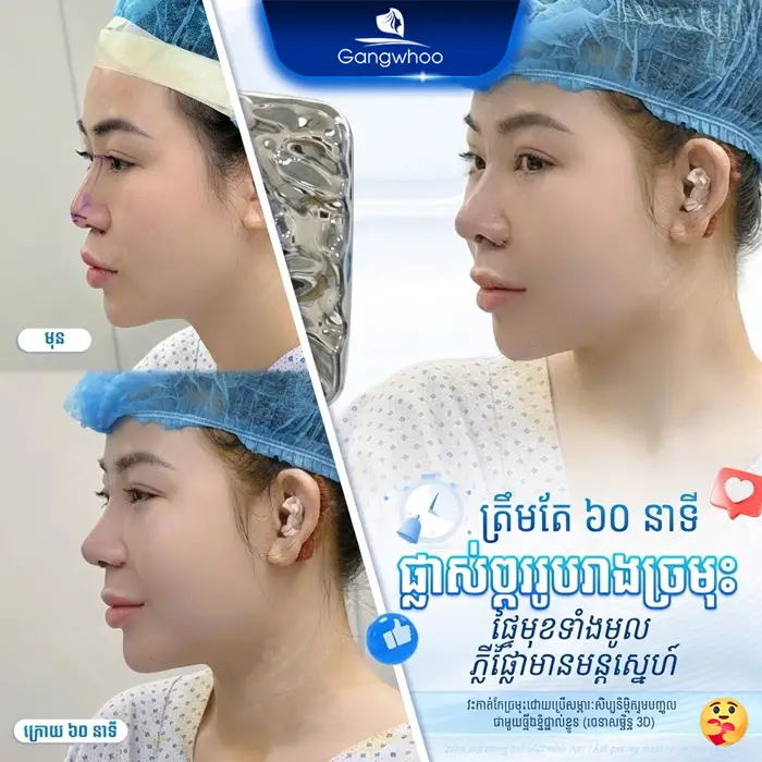 km phau thuat nang mui 4