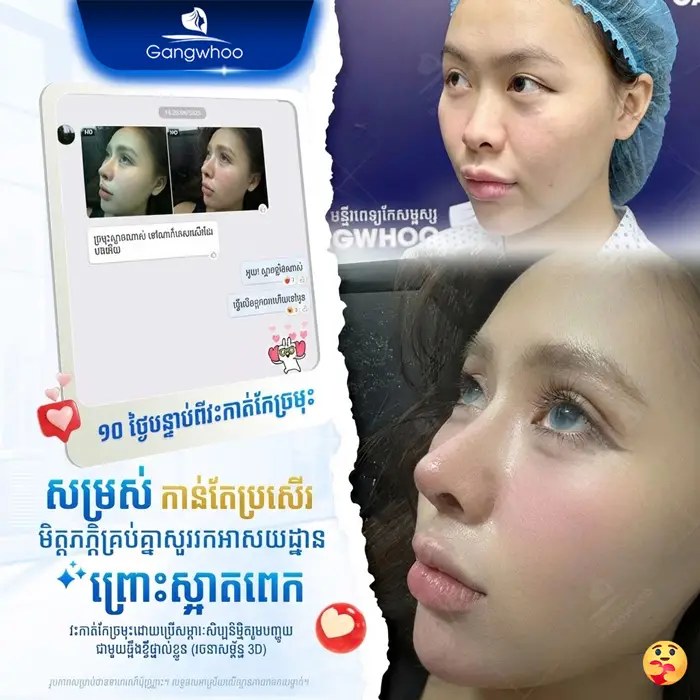 km phau thuat nang mui 5