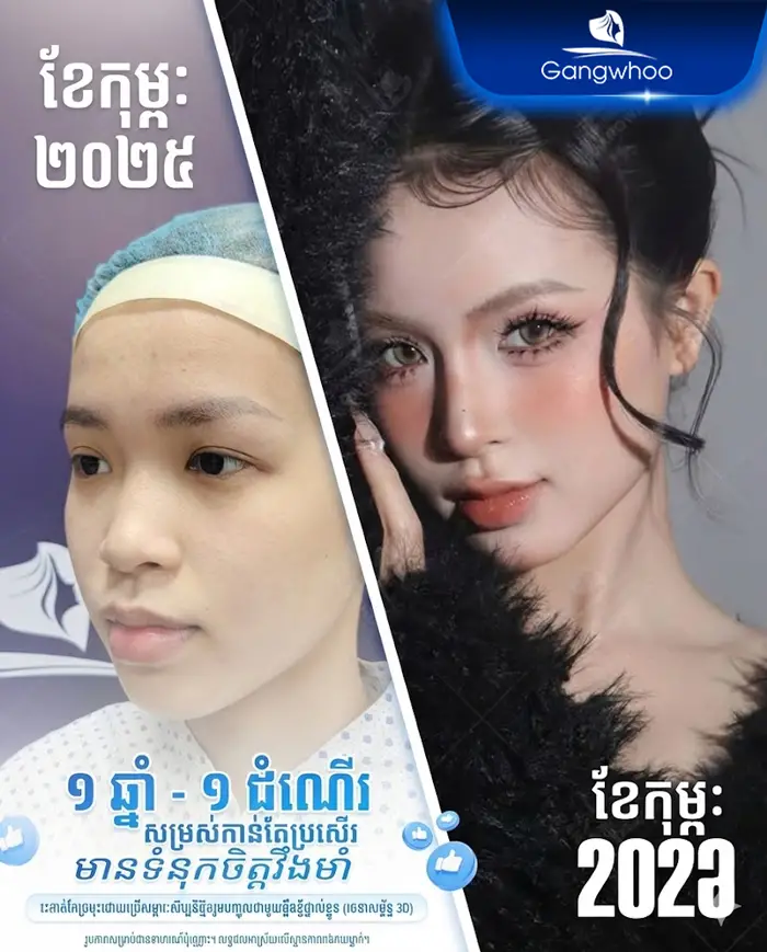 km phau thuat nang mui 6