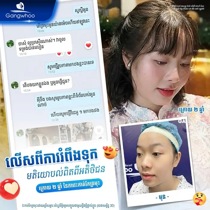 km phau thuat nang mui 7