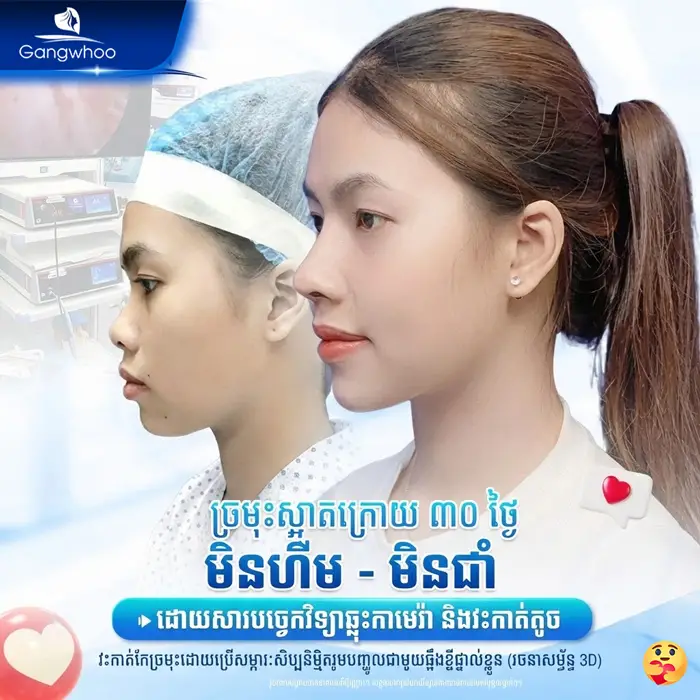 km phau thuat nang mui 8