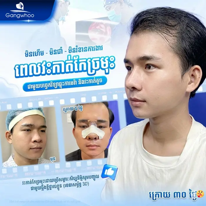 km phau thuat nang mui 9