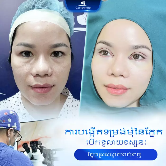 km tao hinh goc mat 2