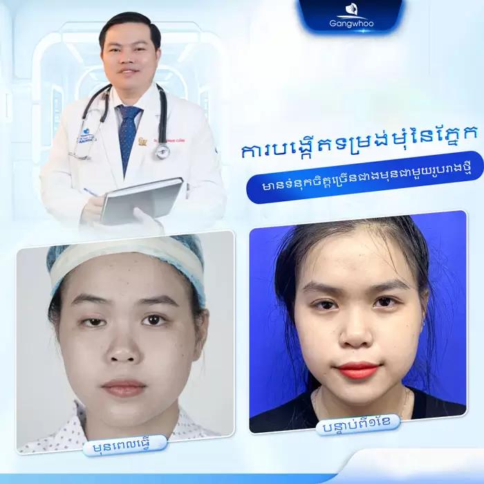 km tao hinh goc mat 4