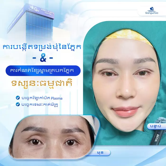 km tao hinh goc mat 6