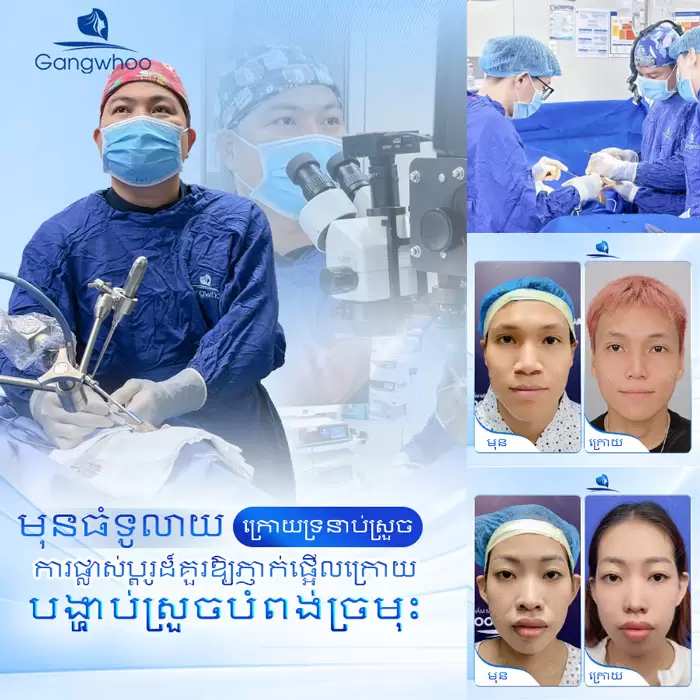 បង្រួមស្លាបច្រមុះ កែច្រមុះធំ ទូលាយ ឱ្យក្លាយជារាងស្លីម 4 km thu gon canh mui 2