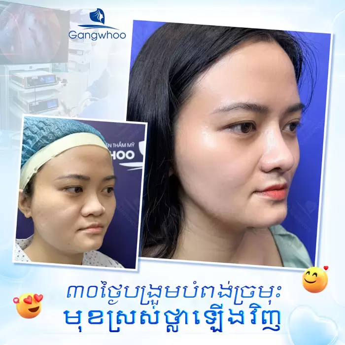 បង្រួមស្លាបច្រមុះ កែច្រមុះធំ ទូលាយ ឱ្យក្លាយជារាងស្លីម 3 km thu gon canh mui 3