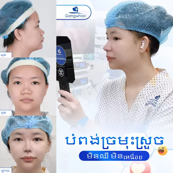 បង្រួមស្លាបច្រមុះ កែច្រមុះធំ ទូលាយ ឱ្យក្លាយជារាងស្លីម 2 km thu gon canh mui 6