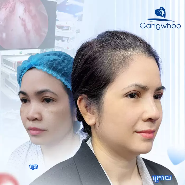 បង្រួមស្លាបច្រមុះ កែច្រមុះធំ ទូលាយ ឱ្យក្លាយជារាងស្លីម 1 km thu gon canh mui 7