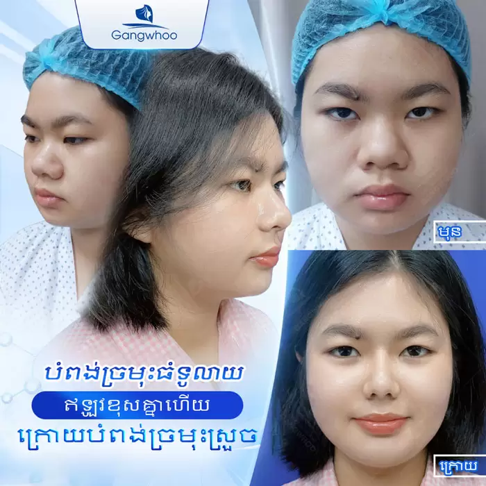 បង្រួមស្លាបច្រមុះ កែច្រមុះធំ ទូលាយ ឱ្យក្លាយជារាងស្លីម 14 km thu gon canh mui 8