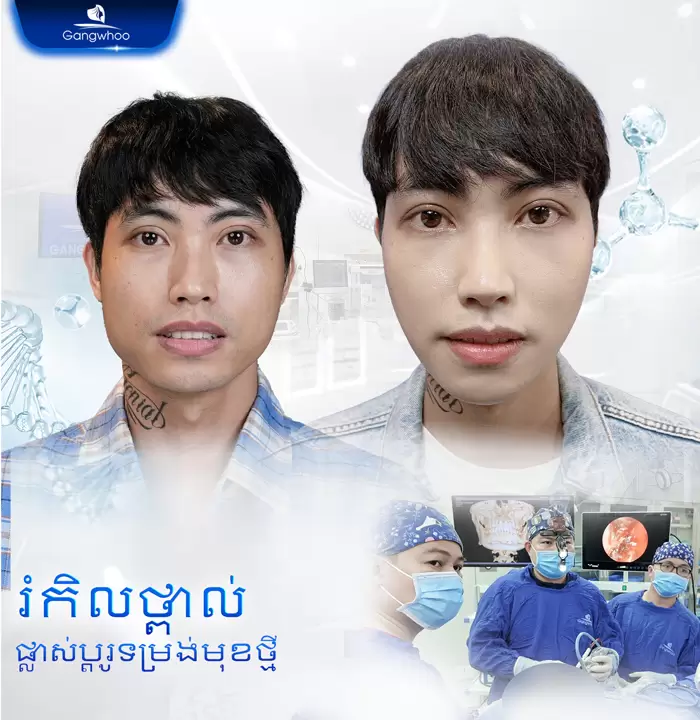 km truot cam 1