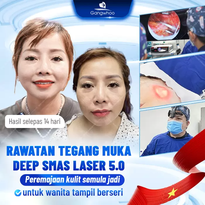 ms cang da mat deep smas laser 1