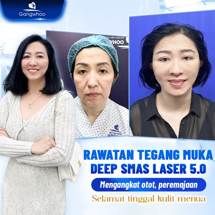 ms cang da mat deep smas laser 6