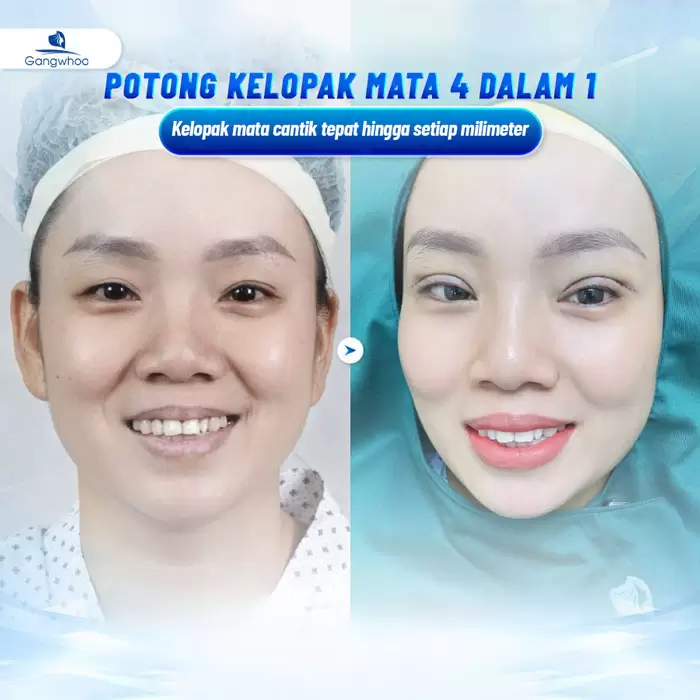 Potongan Kelopak Mata 4 dalam 1 Plasma: Memperbaiki Segala Kekurangan, Mata Dua Kelopak yang Cantik Sempurna 9 ms cat mi 4 in 1 1