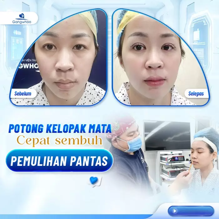 Potongan Kelopak Mata 4 dalam 1 Plasma: Memperbaiki Segala Kekurangan, Mata Dua Kelopak yang Cantik Sempurna 2 ms cat mi 4 in 1 7