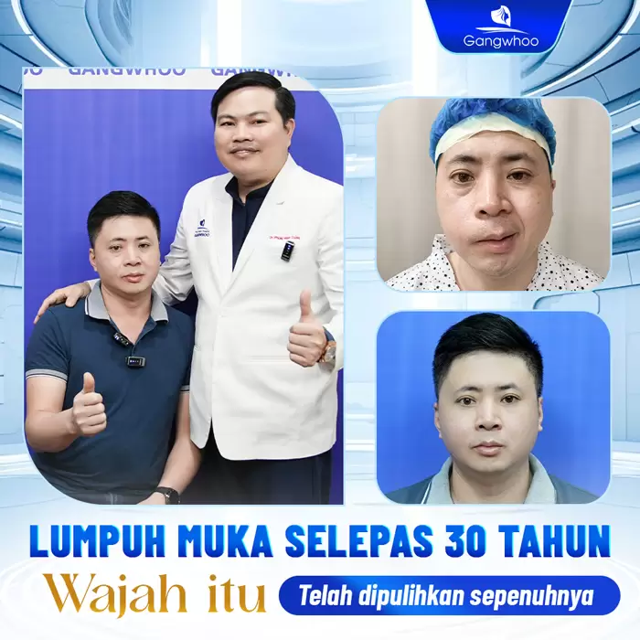 ms dieu tri liet mat 11