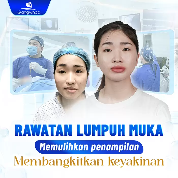 ms dieu tri liet mat 2