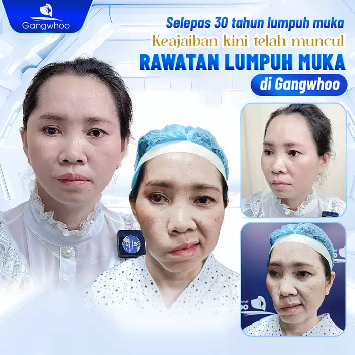 ms dieu tri liet mat 5