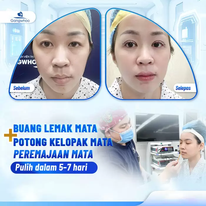 ms lay mo mat noi soi 1