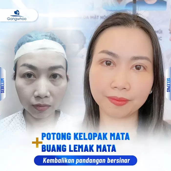 ms lay mo mat noi soi 4