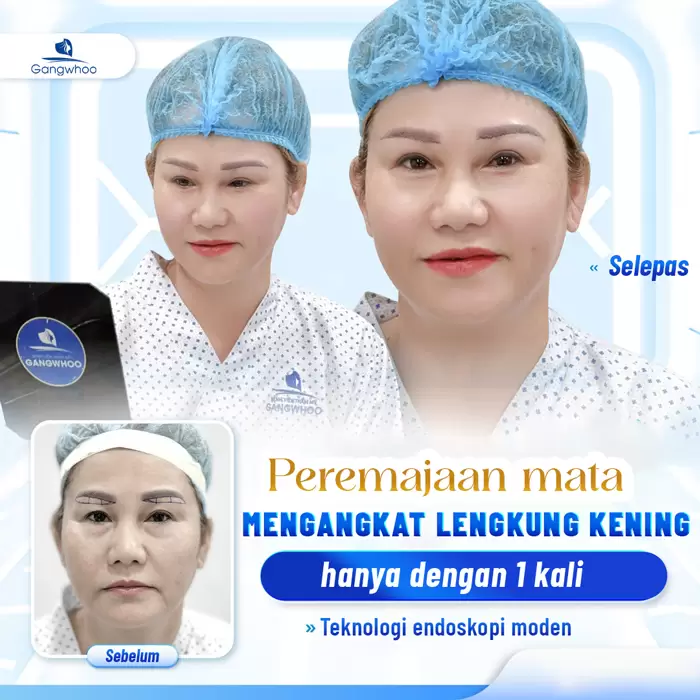 Mengangkat Lengkungan Kening Endoskopi Menghilangkan Tanda-tanda “Penuaan” 4 ms nang cung chan may 8