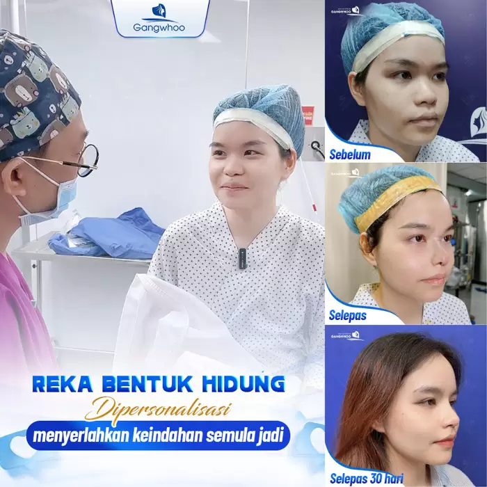 Pembentukan Hidung Surgiform – Tulang Rawan Pembentukan Hidung untuk Hidung yang Kukuh 8 ms nang mui sun surgiform 1
