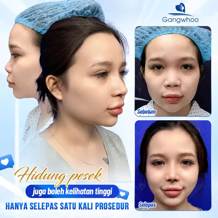 Pembentukan Hidung Surgiform – Tulang Rawan Pembentukan Hidung untuk Hidung yang Kukuh 20 ms nang mui sun surgiform 2
