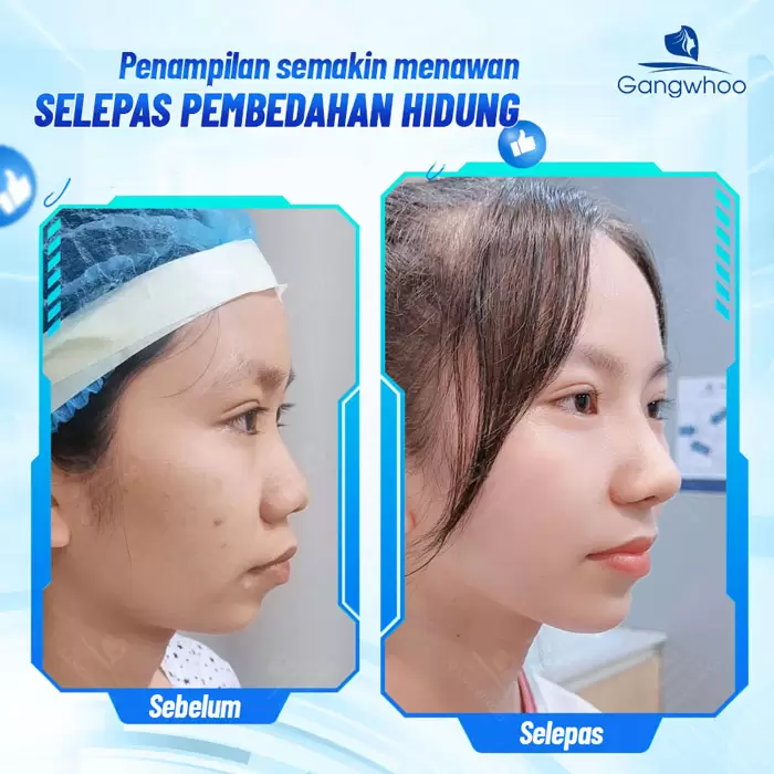 Pembentukan Hidung Surgiform – Tulang Rawan Pembentukan Hidung untuk Hidung yang Kukuh 7 ms nang mui sun surgiform 3