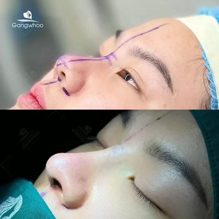 Pembentukan Hidung Surgiform – Tulang Rawan Pembentukan Hidung untuk Hidung yang Kukuh 2 ms nang mui sun surgiform 4