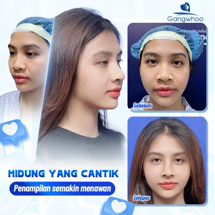 Pembentukan Hidung Surgiform – Tulang Rawan Pembentukan Hidung untuk Hidung yang Kukuh 3 ms nang mui sun surgiform 6