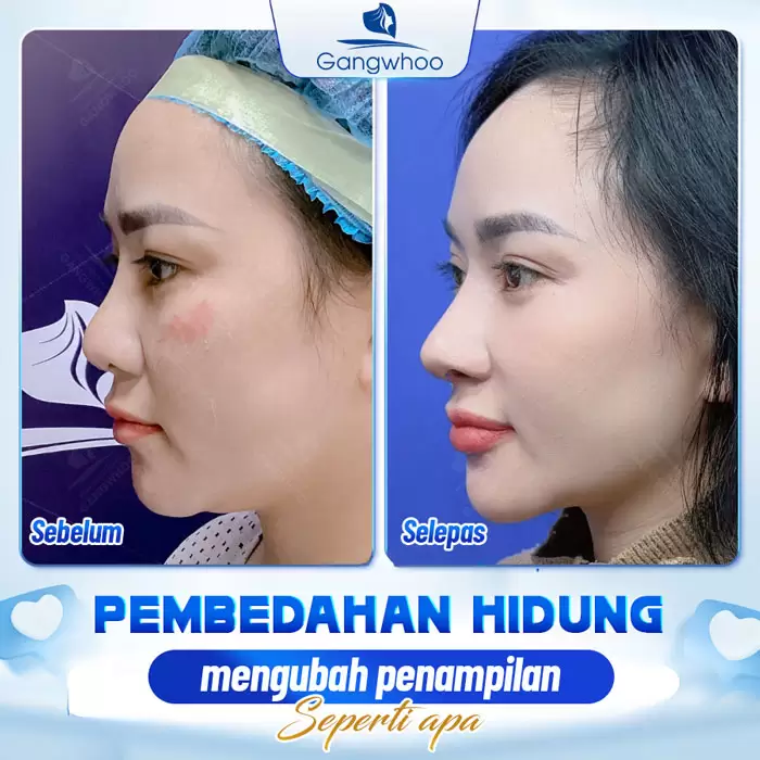 Pembentukan Hidung Surgiform – Tulang Rawan Pembentukan Hidung untuk Hidung yang Kukuh 1 ms nang mui sun surgiform 7