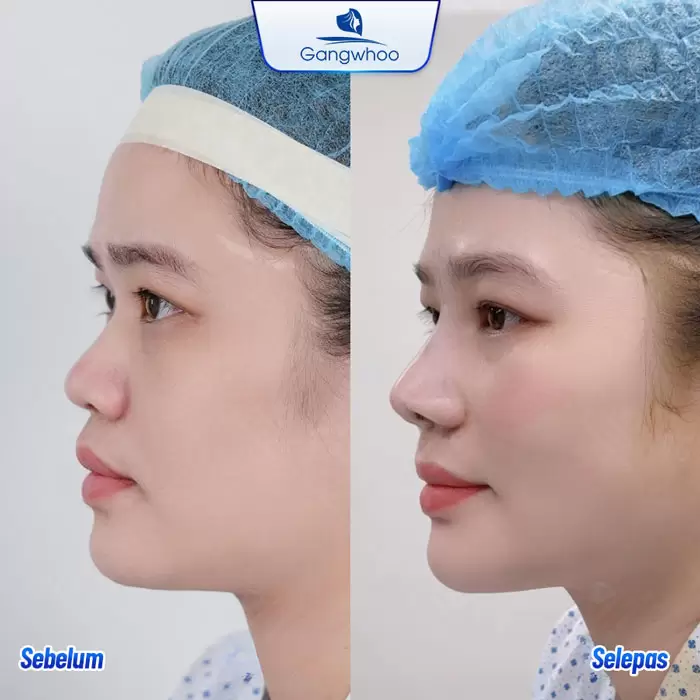 Pembentukan Hidung Surgiform – Tulang Rawan Pembentukan Hidung untuk Hidung yang Kukuh 4 ms nang mui sun surgiform 9
