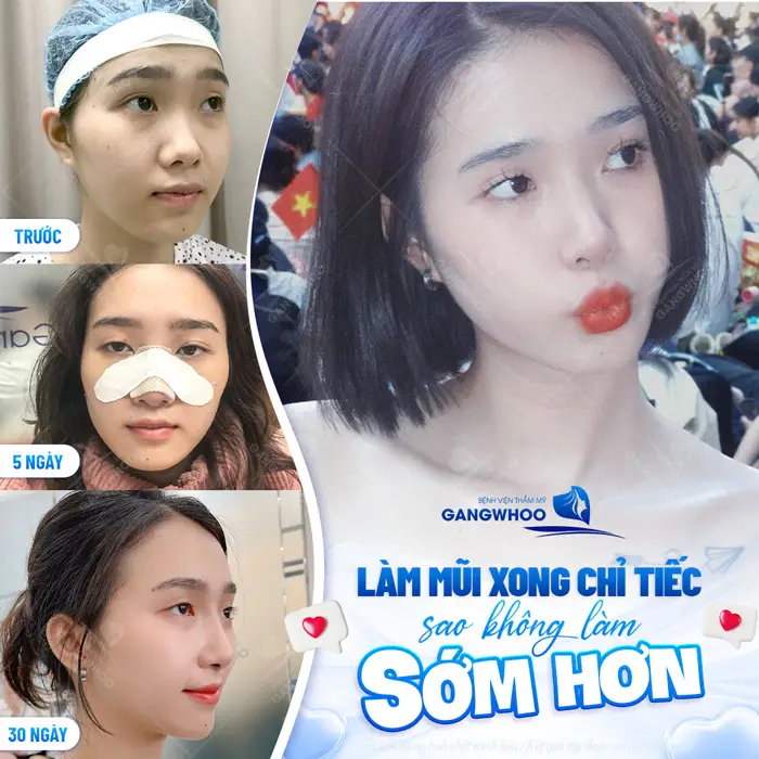 Phẫu Thuật Nâng Mũi Nội Soi 4K Là Gì? Ưu Điểm Và Chi Phí Năm 2025 3 Nâng mũi xong gương mặt đẹp bừng sáng, tràn đầy tự tin và thu hút mọi ánh nhìn
