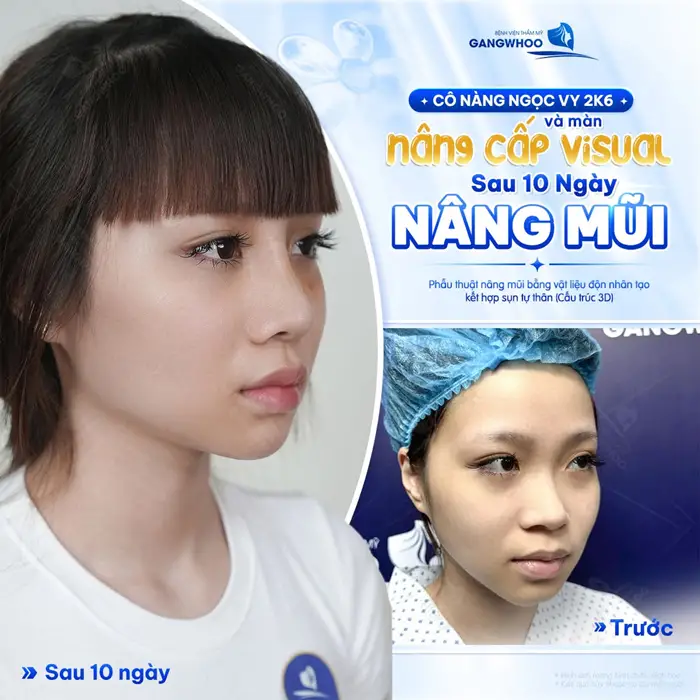 Nâng cấp Visual sau 10 ngày nâng mũi cô nàng GenZ tự tin hơn với diện mạo mới của mình