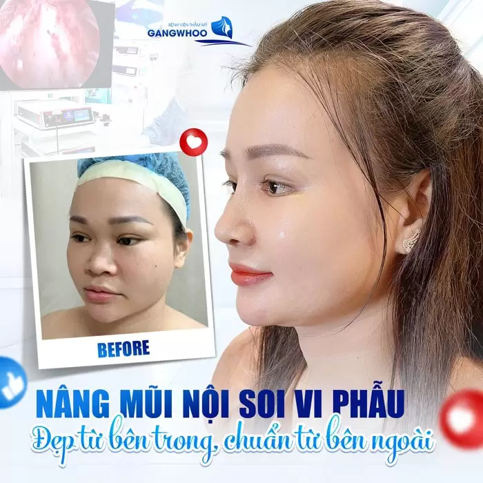 Phẫu Thuật Nâng Mũi Nội Soi 4K Là Gì? Ưu Điểm Và Chi Phí Năm 2025 4 Nâng mũi nội soi vi phẫu
