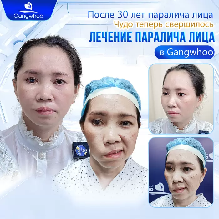 ru dieu tri liet mat 5